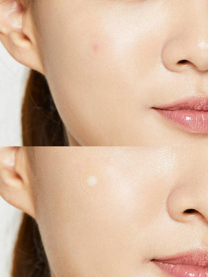 Acne Pimple Master Patch COSRX